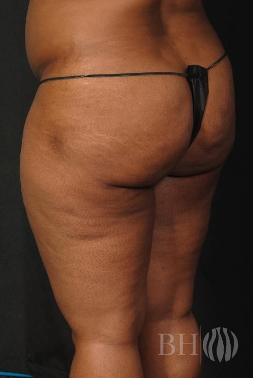 Buttock Augmentation Before & After
