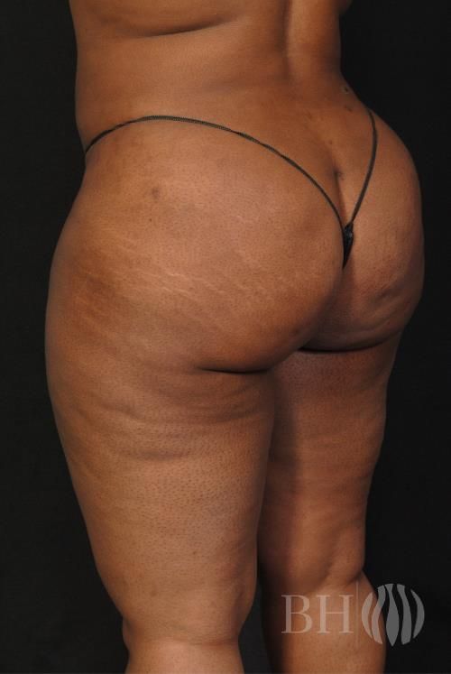 Buttock Augmentation Before & After