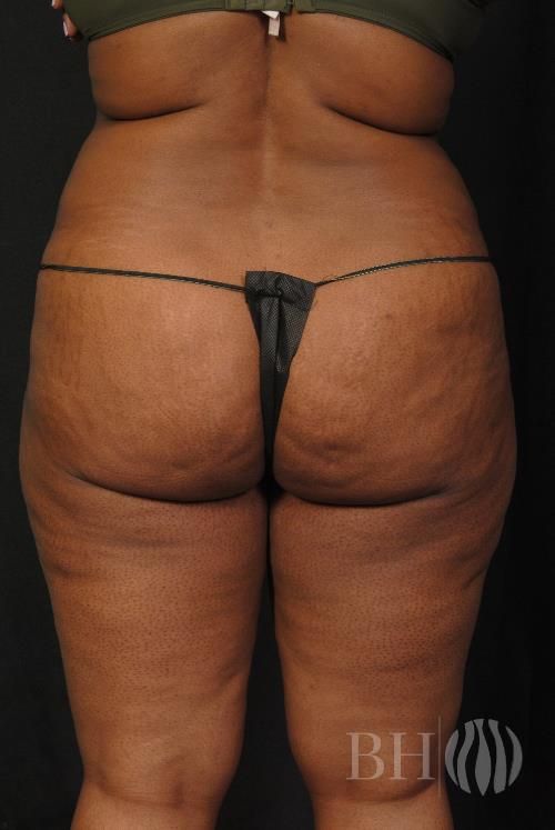 Buttock Augmentation Before & After