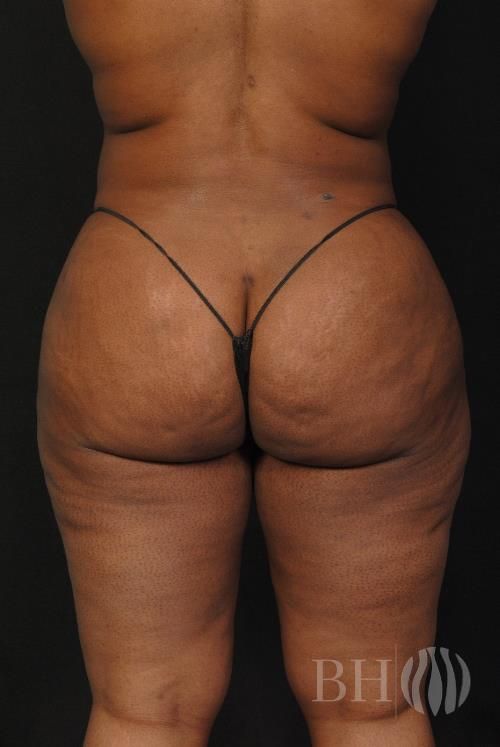 Buttock Augmentation Before & After