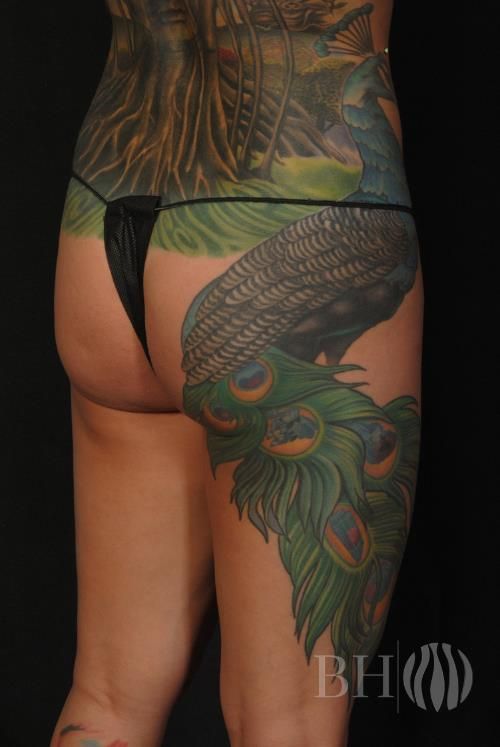 Buttock Augmentation Before & After