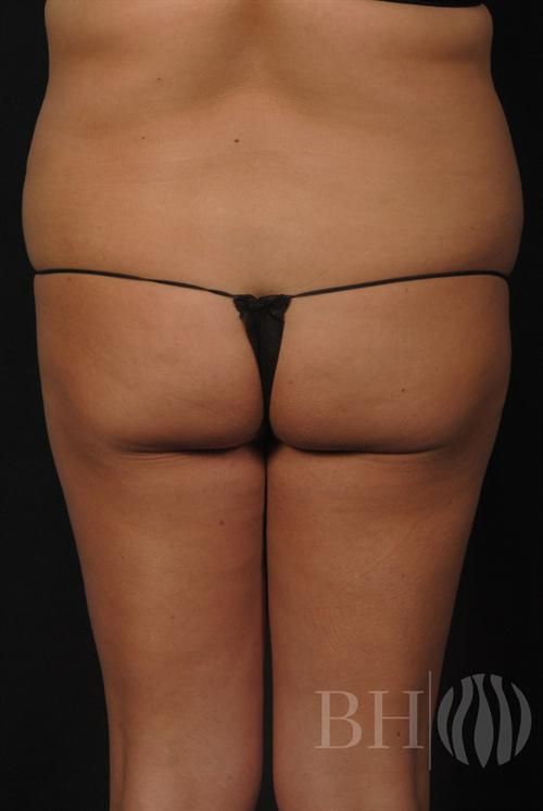 Buttock Augmentation Before & After