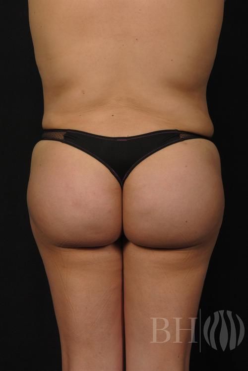 Buttock Augmentation Before & After