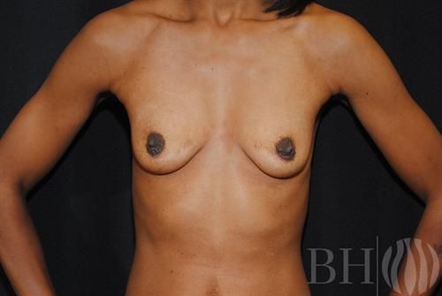 Breast Augmentation Before & After