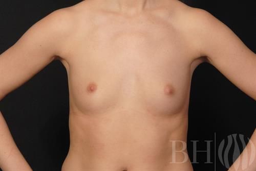 Breast Augmentation Before & After