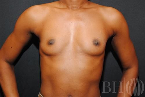 Breast Augmentation Before & After