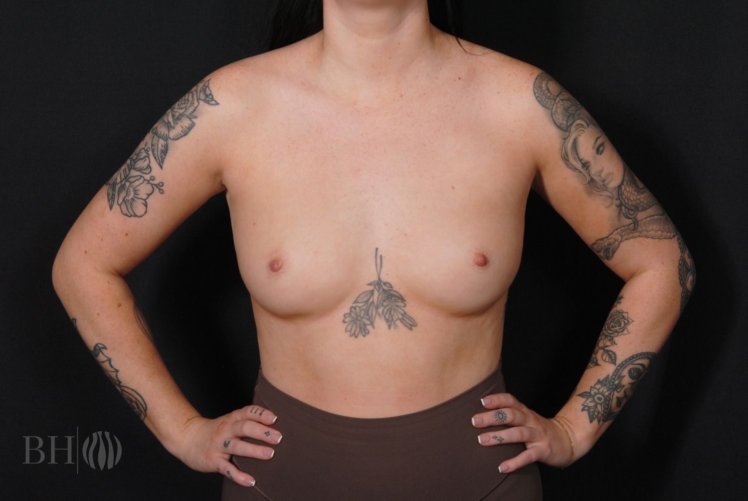 Breast Augmentation Before & After