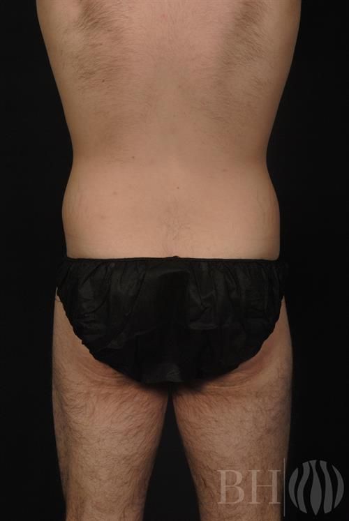 Liposuction Before & After