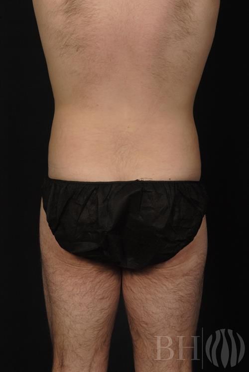 Liposuction Before & After