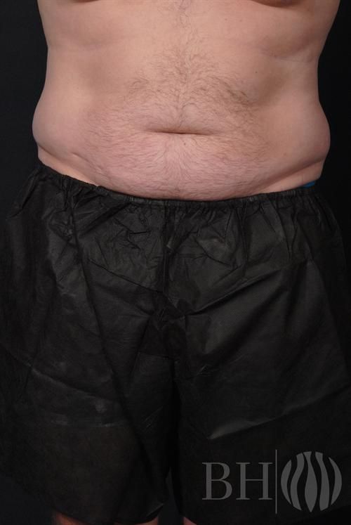 Liposuction Before & After