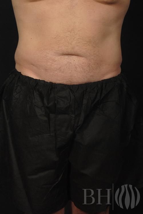 Liposuction Before & After
