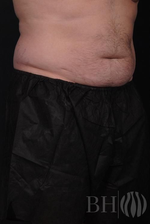 Liposuction Before & After