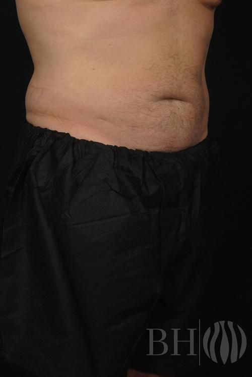 Liposuction Before & After