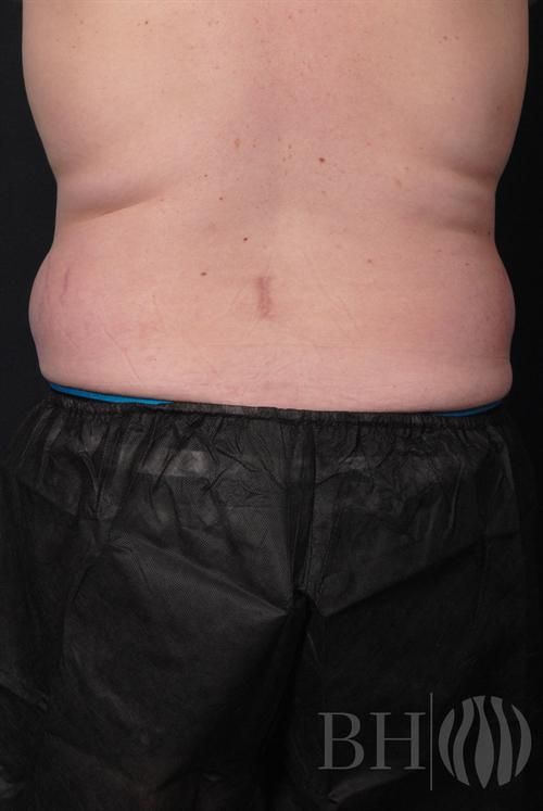 Liposuction Before & After