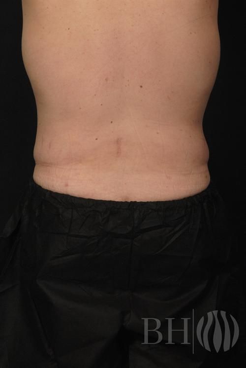 Liposuction Before & After