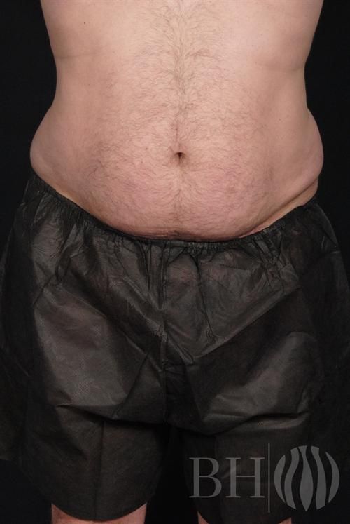 Liposuction Before & After