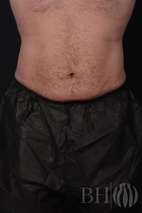 Liposuction Before & After
