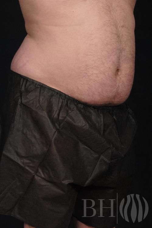 Liposuction Before & After