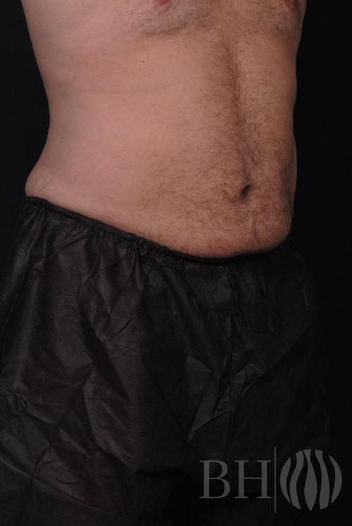 Liposuction Before & After