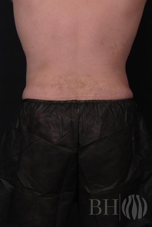 Liposuction Before & After