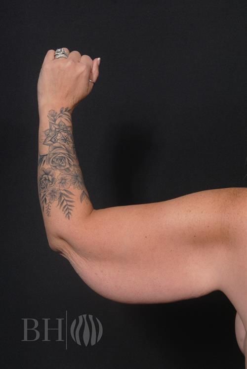 Arm Lift Before & After