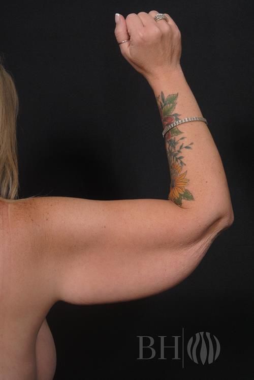 Arm Lift Before & After