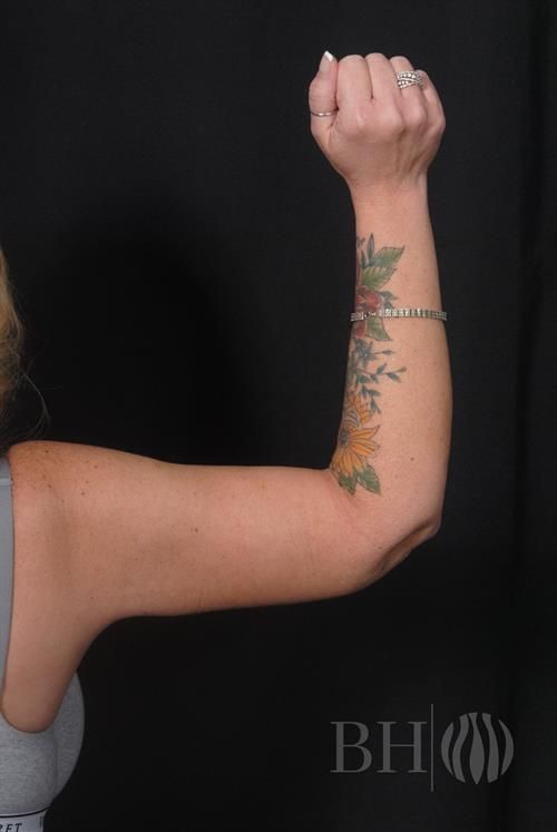 Arm Lift Before & After