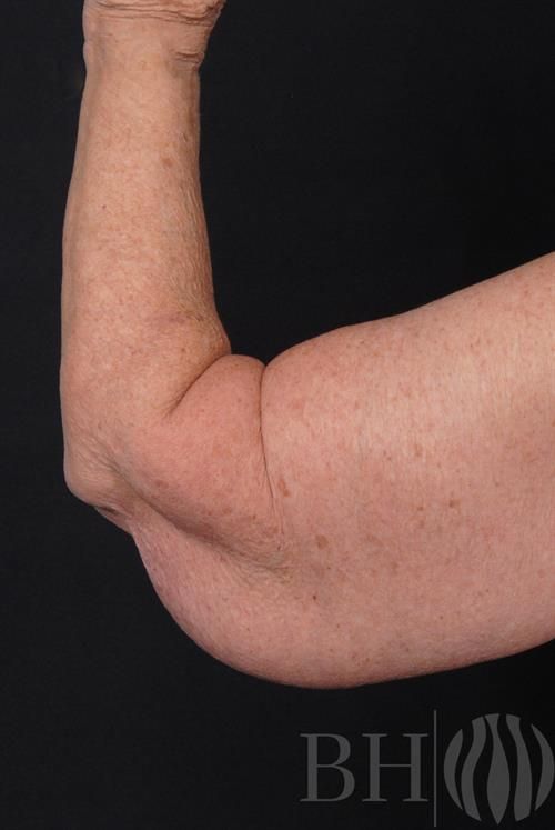 Arm Lift Before & After