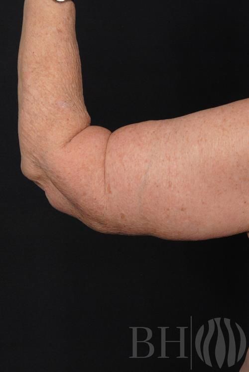 Arm Lift Before & After