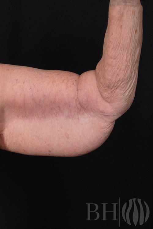 Arm Lift Before & After