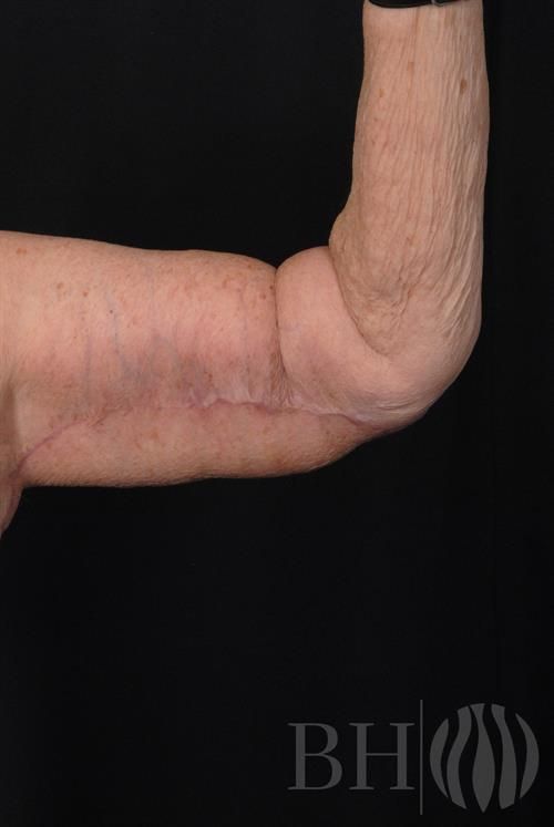 Arm Lift Before & After