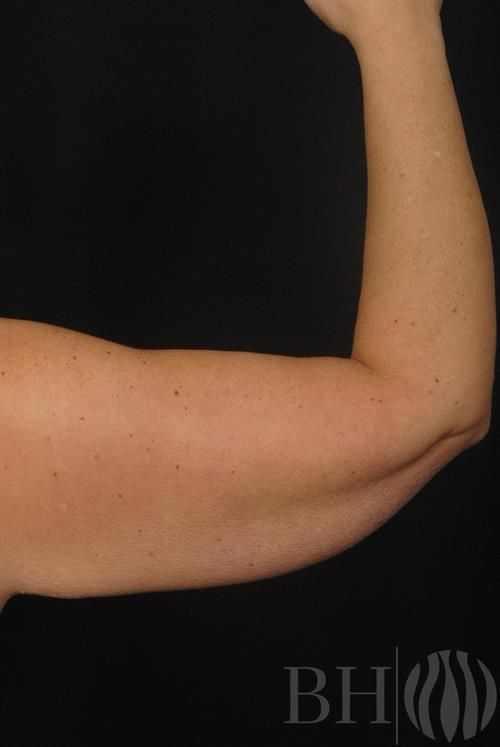 Arm Lift Before & After