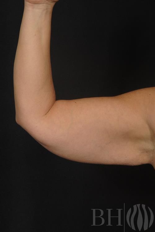 Arm Lift Before & After