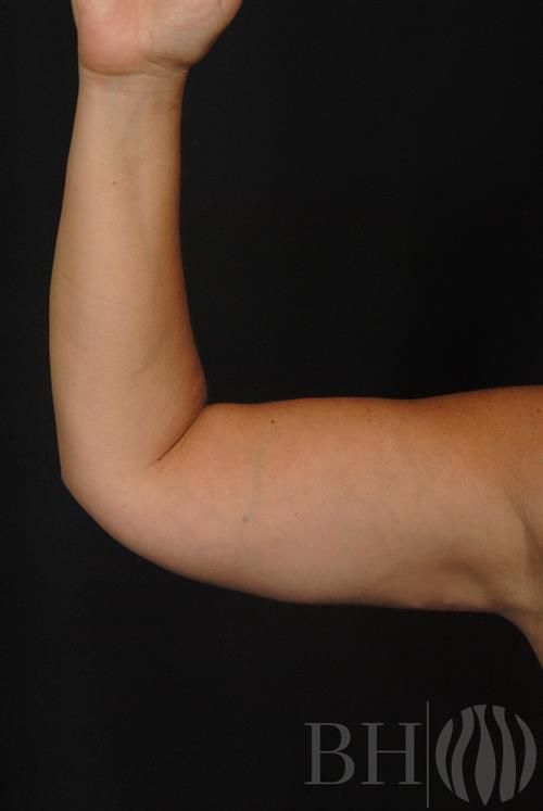 Arm Lift Before & After