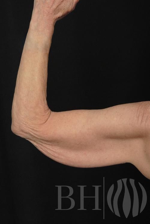 Arm Lift Before & After