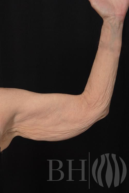 Arm Lift Before & After