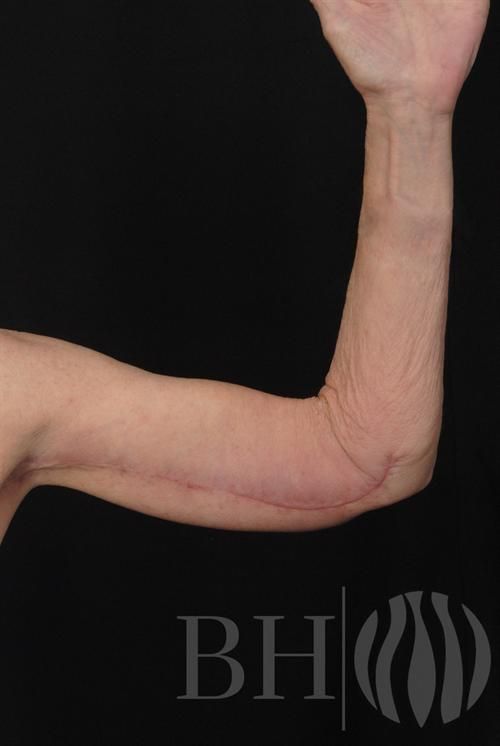 Arm Lift Before & After