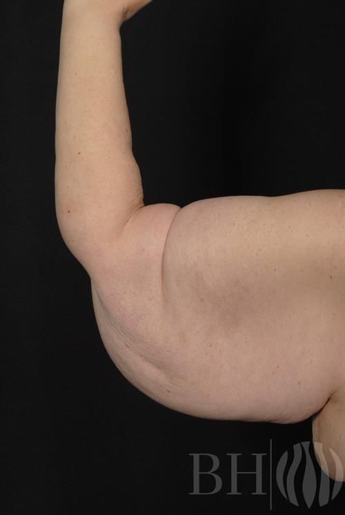 Arm Lift Before & After