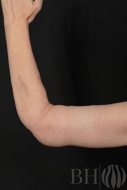 Arm Lift Before & After