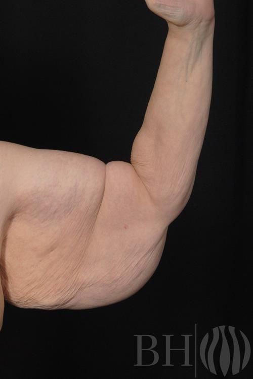 Arm Lift Before & After