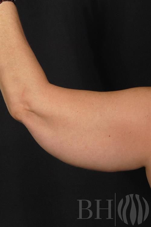 Arm Lift Before & After