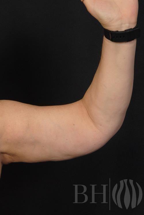 Arm Lift Before & After