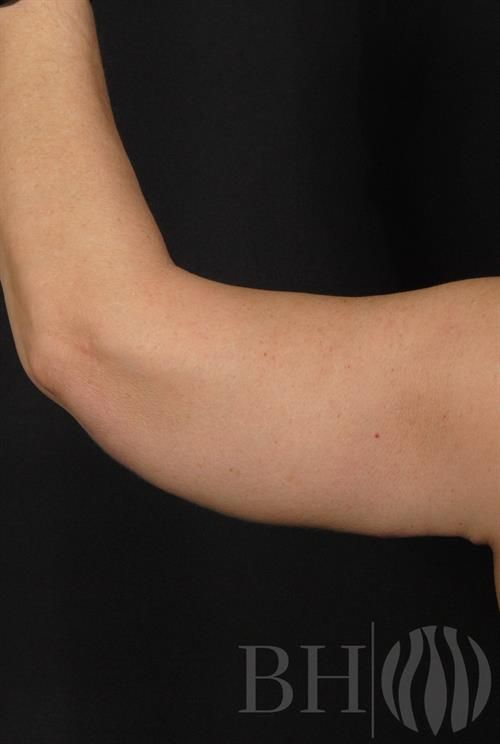 Arm Lift Before & After