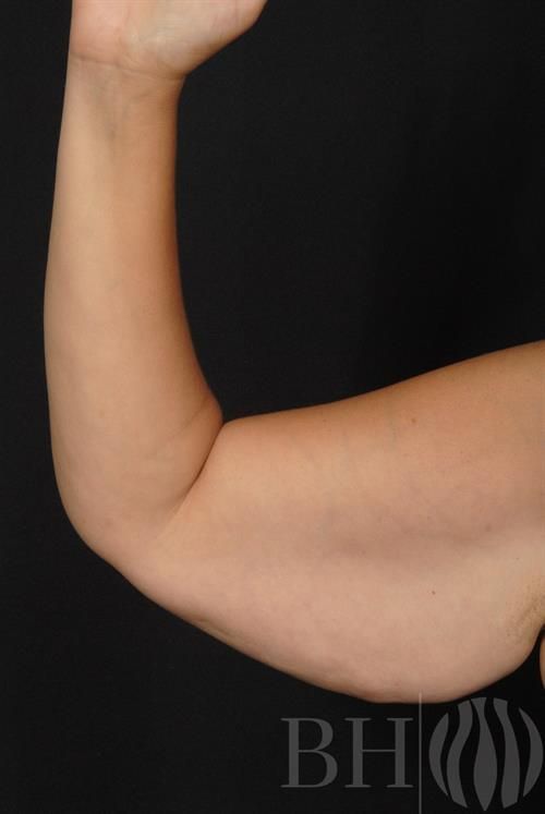 Arm Lift Before & After