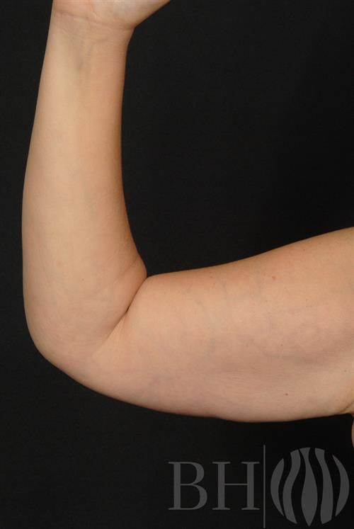 Arm Lift Before & After