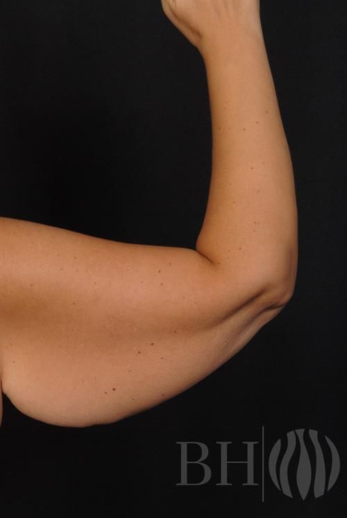 Arm Lift Before & After