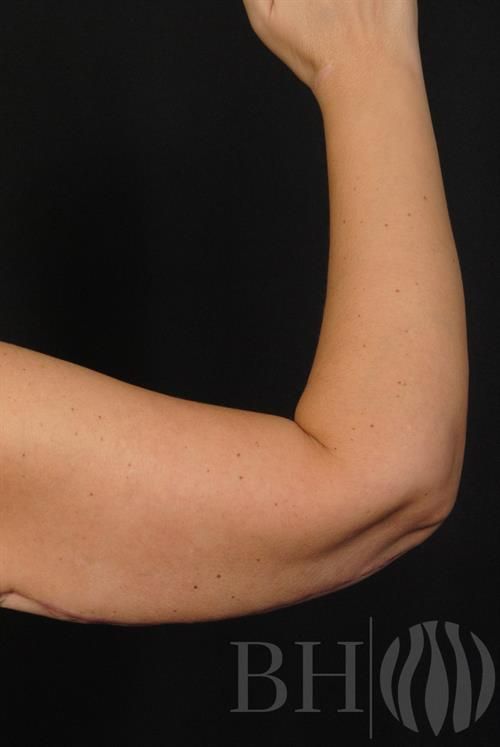 Arm Lift Before & After
