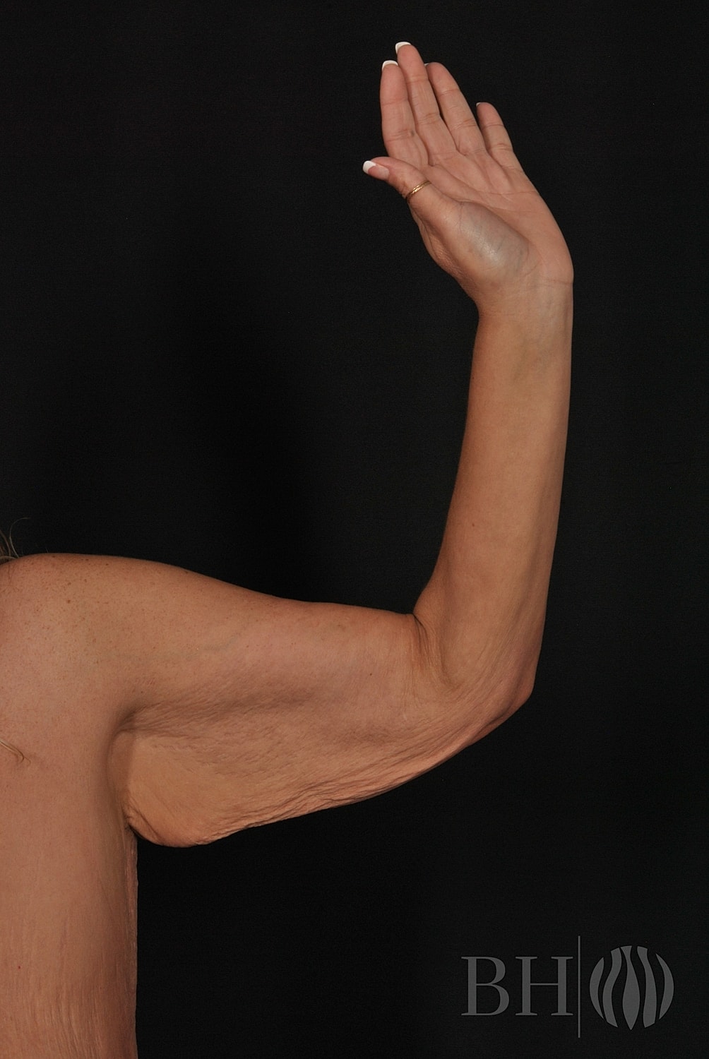 Arm Lift Before & After