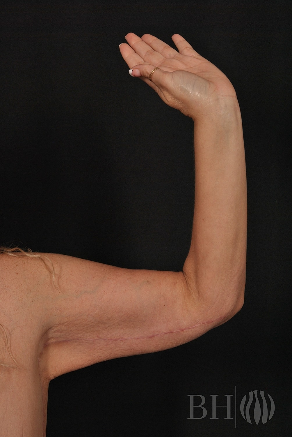 Arm Lift Before & After