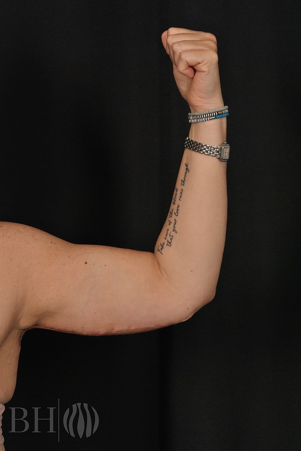 Arm Lift Before & After